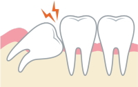 みどり歯科の口腔外科メニュー「親知らずの抜歯」