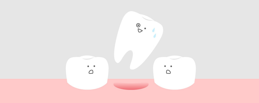 みどり歯科の歯が抜ける原因の解説