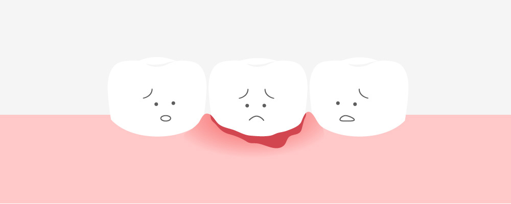 みどり歯科の歯ぐきから出血する原因の解説