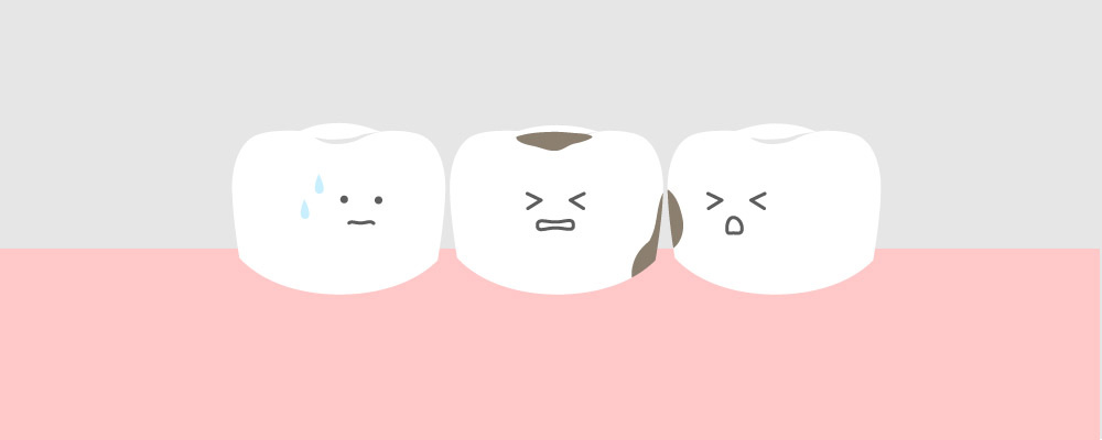 みどり歯科の虫歯ができる原因の解説