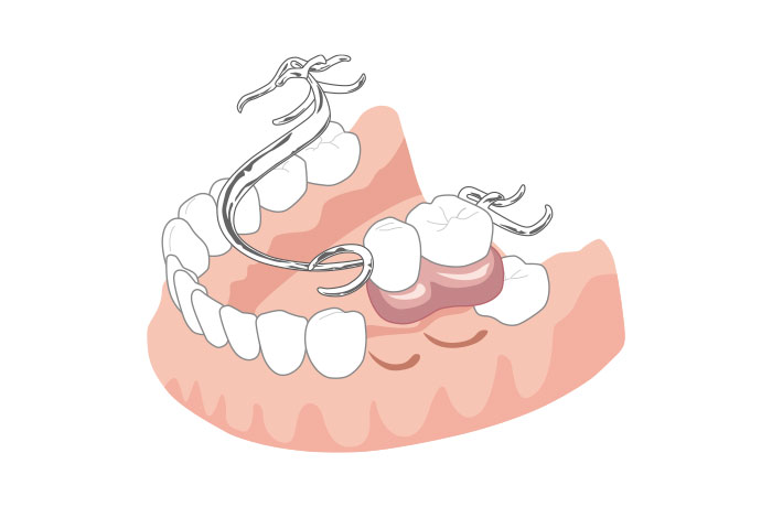 入れ歯のイメージ画像