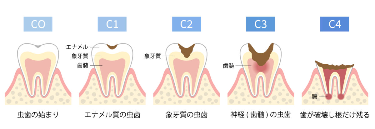虫歯の進行と症状のイラスト