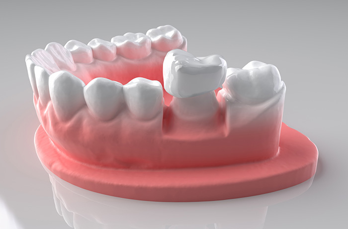スキャナした歯の3D画像